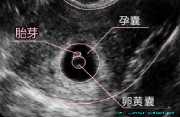 三代试管婴儿要多少钱-做试管对女人的危害4大危害！