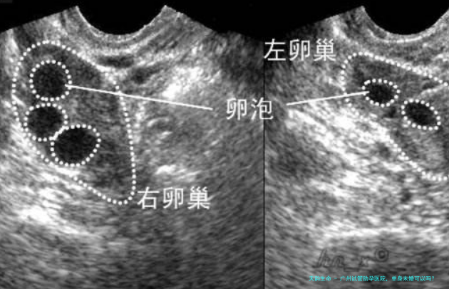 广州试管助孕医院，单身未婚可以吗？