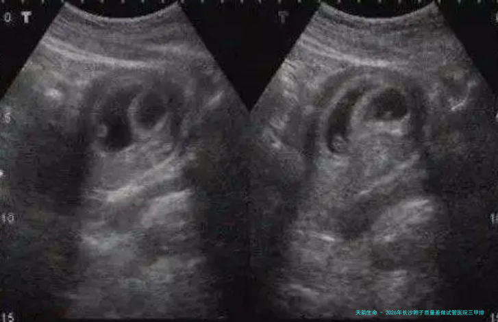 2026年长沙卵子质量差做试管医院三甲排名：湘雅医院、湖南省妇幼等生殖中心推荐